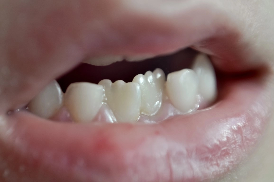 What Are Mamelons On Teeth, And Should You Be Concerned? What Are Mamelons on Teeth, and Should You Be Concerned?